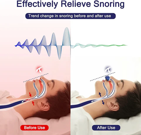 Mini Anti-snorkeenhed i Medicinsk Silikone til Rejser